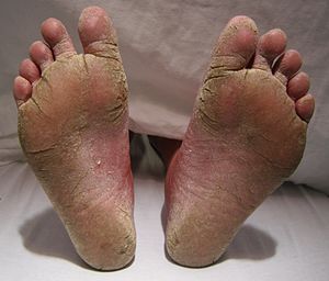 300px-FeetFungal