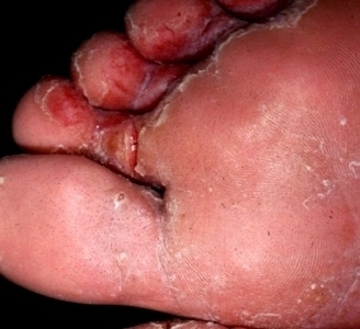 Athletes_foot_Pict_Plantar_21