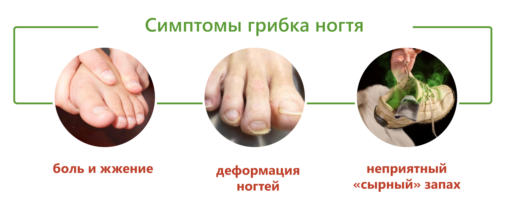 Микоз